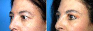 48 Year Old Unhappy With The Extra Skin In Her Upper Eyelids With Doctor John J. Martin, Jr., MD, Coral Gables Oculoplastic Surgeon