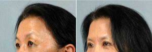 48 Year Old Woman Treated With Asian Eyelid Surgery With Dr. Suzanne Yee, MD, Little Rock Facial Plastic Surgeon