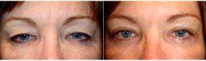 49 Year Old Woman Treated With Upper And Lower Eyelid Surgery With Doctor Boaz J. Lissauer, MD, New York Oculoplastic Surgeon