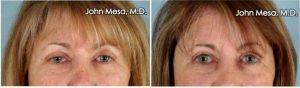 51 Year Old Woman Treated With Eyelid Surgery For Sleepy Eyes ( Upper Lid Ptosis Repair Lift) By Doctor John Mesa, MD, New York Plastic Surgeon