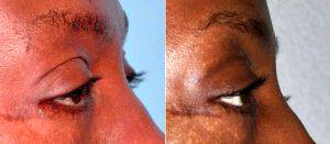52 Year Old Female Treated For Extra Upper Eyelid Skin With Dr. Barry L. Eppley, MD, DMD, Indianapolis Plastic Surgeon