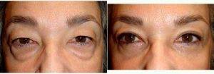 53 Year Old Woman Treated With Upper And Lower Eyelid Surgery By Dr. Boaz J. Lissauer, MD, New York Oculoplastic Surgeon
