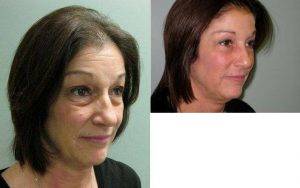 55 Year Old Lady With Heavy Upper Eyelids And Bags Under Her Eyes With Dr Beth Collins, MD, New Haven Plastic Surgeon
