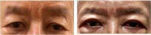 55 Year Old Man Treated With Asian Eyelid Surgery By Doctor Sean Paul, MD, Austin Oculoplastic Surgeon