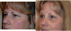 57 Year Old Female Underwent Concurrent Upper Eyelid Blepharoplasty And Brow Lift Surgery With Dr. Ryan Mitchell, DO, FAOCO, Henderson Facial Plastic Surgeon