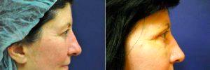 58 Year Old Female Treated For Excess Upper Eyelid Skin With Doctor Jennifer Reichel, MD, Seattle Dermatologist