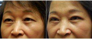 59 Year Old Woman Treated With Asian Eyelid Surgery By Doctor Kun Z. Kim, MD, Atlanta Facial Plastic Surgeon