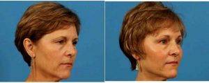 60 Year Old Woman Treated With Upper Eyelid Surgery By Doctor Brian Coan, MD, FACS, Raleigh-Durham Plastic Surgeon