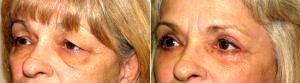 62 Year Old Female Before And After Upper And Lower Eyelid Blepharoplasty And Canthoplasty Before By Dr. Ryan Mitchell, DO, FAOCO, Henderson Facial Plastic Surgeon
