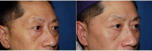 63 Year Old Man Treated With Asian Eyelid Surgery With Dr William Portuese, MD, Seattle Facial Plastic Surgeon