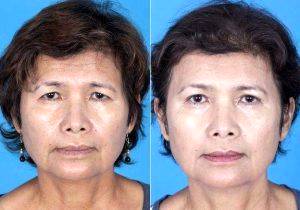 68 Year Old Asian Female With Excessive Eyelid Skin And Brow Ptosis By Dr Jose E. Barrera, MD, FACS, San Antonio Facial Plastic Surgeon
