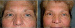 69 Year Old Woman Who Had An Upper Lid Blepharoplasty With Doctor Heather Rocheford, MD, Minneapolis Plastic Surgeon