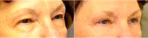 70 Year Old Woman Treated For Obstructing Upper Eyelids And Sagging Lower Eyelids With Doctor A. Dean Jabs, MD, PhD, FACS, Bethesda Plastic Surgeon