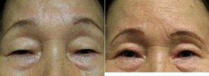 71 Year Old Woman Treated With Asian Eyelid Surgery With Doctor Andres G. Sarraga, MD, FACS, Aventura Plastic Surgeon