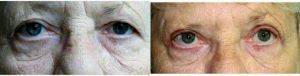 72 Year Old Woman Treated With Upper Eyelid Surgery With Dr. Keshav Magge, MD, Bethesda Plastic Surgeon
