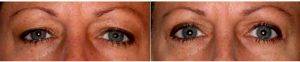 And After Upper Blepharoplasty Before By Doctor Mitesh Kapadia, MD, PhD, Boston Oculoplastic Surgeon