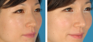 Asian Eyelid Surgery Before After By Doctor David W. Kim, MD, Bay Area Facial Plastic Surgeon (1)