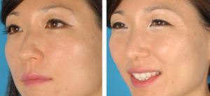Asian Eyelid Surgery Before After By Doctor David W. Kim, MD, Bay Area Facial Plastic Surgeon (2)