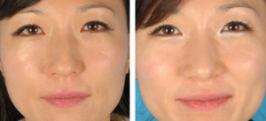 Asian Eyelid Surgery Before After By Doctor David W. Kim, MD, Bay Area Facial Plastic Surgeon (3)