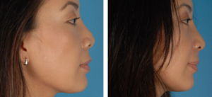 Asian Eyelid Surgery By Dr. David W. Kim, MD, Bay Area Facial Plastic Surgeon