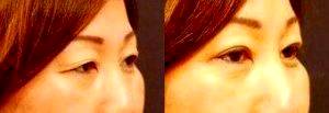 Asian Eyelid Surgery For Excess Skin With Dr. Chase Lay, MD, Bay Area Facial Plastic Surgeon