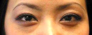 Asian Eyelid Surgery With Dr James Chan, MD, Portland Facial Plastic Surgeon