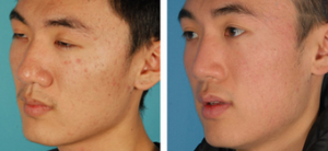 Asian Eyelid Surgery With Dr. David W. Kim, MD, Bay Area Facial Plastic Surgeon