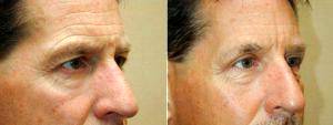 BIlateral Upper Bleph With Brow Hitch By Doctor James Wire, MD, Minneapolis Plastic Surgeon 794