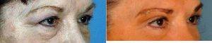 Bilateral Upper And Lower Lid Blepharoplasty With Dr Giancarlo Zuliani, MD, Rochester Facial Plastic Surgeon