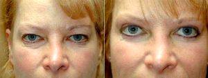 Bilateral Upper Blepharoplasty And Lower Lid Pinch Before And After By Dr James Wire, MD, Minneapolis Plastic Surgeon (1)