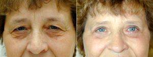 Bilateral Upper Blepharoplasty And Lower Lid Pinch Before And After By Dr James Wire, MD, Minneapolis Plastic Surgeon (3)
