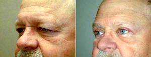 Bilateral Upper Blepharoplasty With Dr. James Wire, MD, Minneapolis Plastic Surgeon