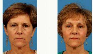 Doctor Brian Coan, MD, FACS, Raleigh-Durham Plastic Surgeon - 59 Year Old Woman Treated With Upper Eyelid Surgery
