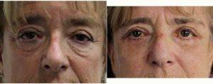 Doctor Daniel Ezra, MD, FRCS, London Oculoplastic Surgeon - Upper And Lower Lid Blepharoplasty With Canthoplasty And Mid-face Lift