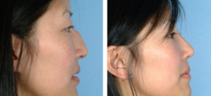 Doctor David W. Kim, MD, Bay Area Facial Plastic Surgeon - Asian Eyelid Surgery Before And After (1)