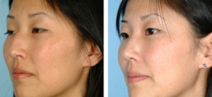 Doctor David W. Kim, MD, Bay Area Facial Plastic Surgeon - Asian Eyelid Surgery Before And After (2)