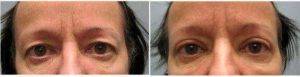 Doctor Della C. Bennett, MD, Rancho Cucamonga Plastic Surgeon - 62 Year Old Woman Treated With Upper Eyelid Surgery