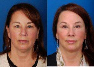 Doctor James M. Ridgway, MD, FACS, Bellevue Facial Plastic Surgeon - Bilateral Upper And Lower Blepharoplasties With Submentoplasty