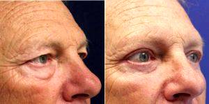 Doctor Jason S. Cooper, MD, Jupiter Plastic Surgeon - 63 Year Old Man Treated With Eyelid Surgery (Upper Lower Blepharoplasty)