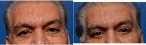Doctor Kian Karimi, MD, FACS, Los Angeles Facial Plastic Surgeon - Upper Lid Blepharoplasty (Eyelid Surgery)
