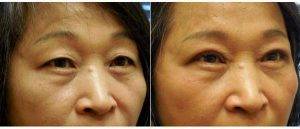 Doctor Kun Z. Kim, MD, Atlanta Facial Plastic Surgeon - 57 Year Old Woman Treated With Asian Eyelid Surgery Before After (1)