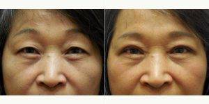 Doctor Kun Z. Kim, MD, Atlanta Facial Plastic Surgeon - 57 Year Old Woman Treated With Asian Eyelid Surgery Before After (2)