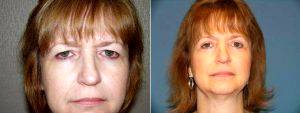Doctor Mark Berkowitz, MD, Sterling Heights Oculoplastic Surgeon - Endoscopic Browlift, Upper And Lower Eyelid Surgery