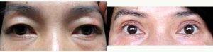 Doctor Parviz Goshtasby, MD, FACS, Newport Beach Plastic Surgeon - 36 Year Old Woman Treated With Asian Eyelid Surgery