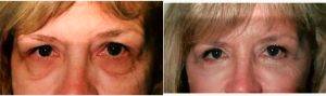 Doctor Steven H. Wiener, MD, Scottsdale Plastic Surgeon - Eyelid Surgery With Upper And Lower