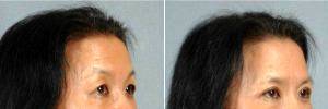 Doctor Suzanne Yee, MD, Little Rock Facial Plastic Surgeon - 50 Year Old Woman Treated With Asian Eyelid Surgery