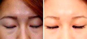 Double Eyelid Before And After Photos Before With Dr. Thomas Buonassisi, MD, Vancouver Facial Plastic Surgeon (1)