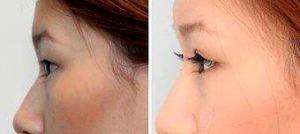 Double Eyelid Before And After Photos Before With Dr. Thomas Buonassisi, MD, Vancouver Facial Plastic Surgeon (3)