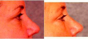 Dr A. Dean Jabs, MD, PhD, FACS, Bethesda Plastic Surgeon - 50 Y.o. Upper Eyelid Rejuvenation