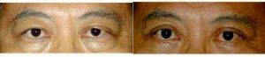 Dr Albert W. Chow, MD, San Francisco Plastic Surgeon - 52 Year Old Man Treated With Asian Eyelid Surgery